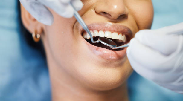 Best Emergency Wisdom Teeth Removal in Ferguson, MO